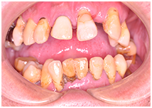 40代男性 重度の歯周病 初診時の口腔内写真