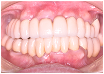 50代男性 重度の歯周病 治療後の口腔内写真