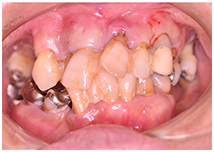 50代男性 重度の歯周病 初診時の口腔内写真